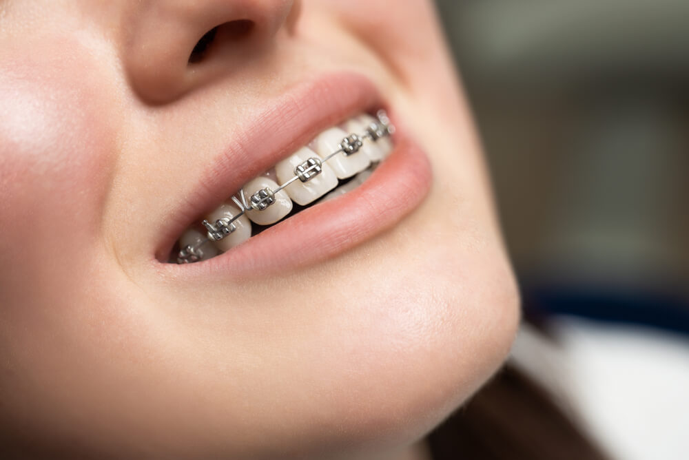 How Clear Braces Work